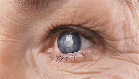 Глаукома симптомы признаки