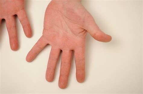 Перепонки между пальцами