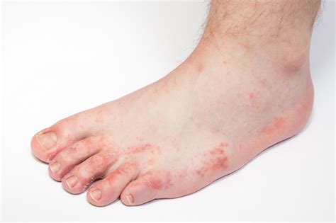 Аллергический дерматит на ногах