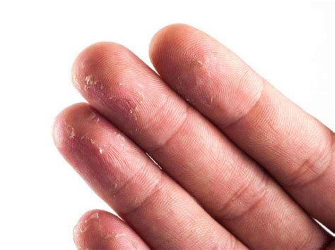 Почему шелушится кожа на руках